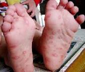 what is foot and mouth disease