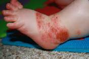 what is foot and mouth disease